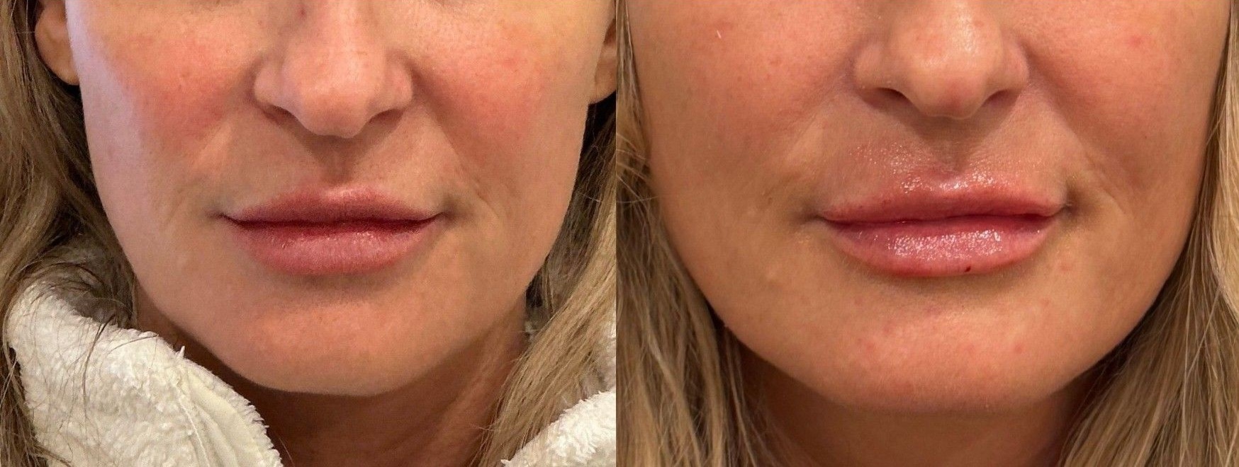 Lip Filler - Before & After